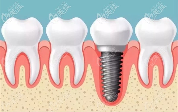 寮步莞大口腔的美国皓圣种植牙参考价格 寮步莞大口腔的美国皓圣种植牙参考价格