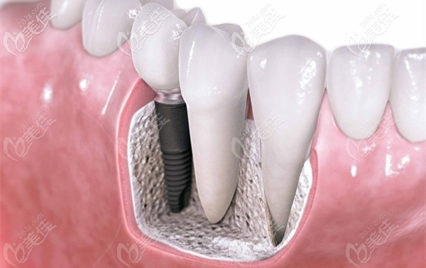 东莞莞大口腔的瑞士ITI种植牙参考价格 东莞莞大口腔的瑞士ITI种植牙参考价格