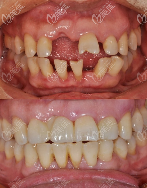 60岁牙周炎门牙松动患者选择在咸阳美好齿科做正畸种植综合治疗
