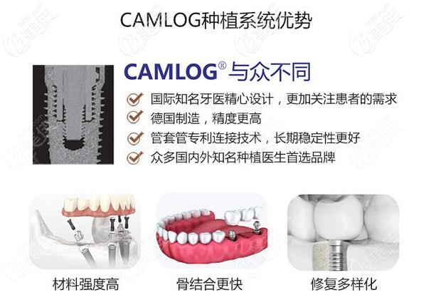 德国camlog种植牙优势