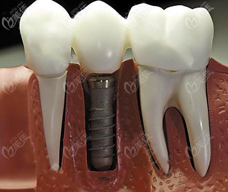 做德国camlog种植体操作示意图