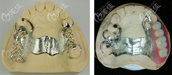 活动牙支架示意图
