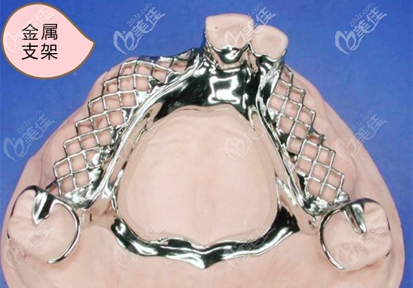 活动义齿的金属支架图 活动义齿的金属支架图
