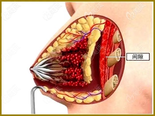 为什么说做假体隆胸,想隐蔽伤口就选择乳晕切口呢?