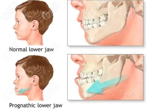 儿童地包天牙齿突出示意图 儿童地包天牙齿突出示意图