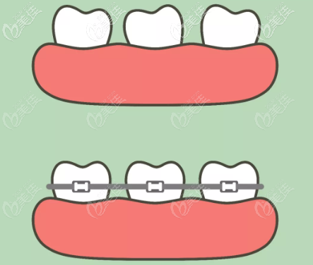 儿童地包天矫正带牙套示意图 儿童地包天矫正带牙套示意图