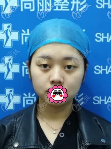 到宁波尚丽做双眼皮前 到宁波尚丽做双眼皮前