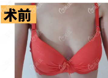 在韩国做375CC魔滴假体隆胸前 在韩国做375CC魔滴假体隆胸前