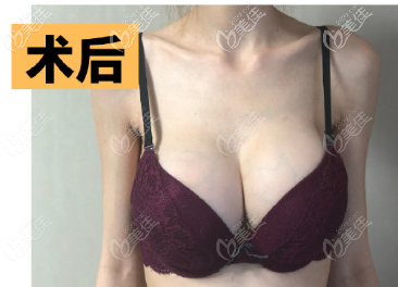 金祐正医生给我做魔滴假体隆胸一个月效果 金祐正医生给我做魔滴假体隆胸一个月效果