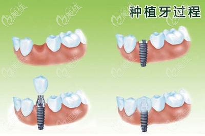 种植牙的过程