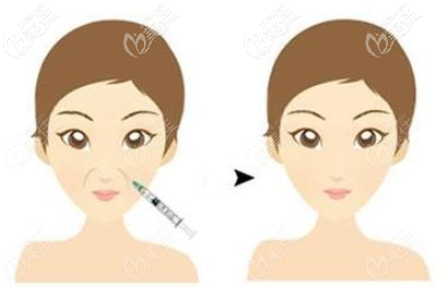 法令纹注射的效果