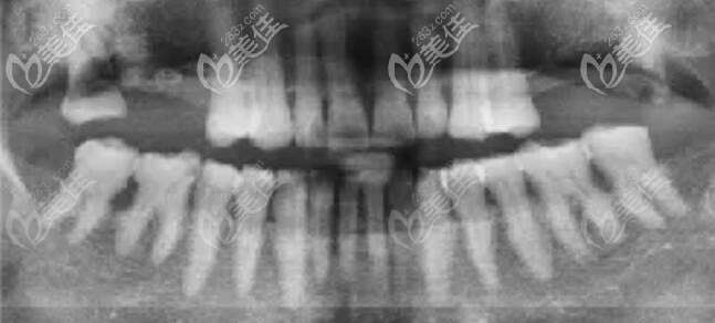 上半口缺失四颗牙,多年缺牙牙槽骨萎缩 上半口缺失四颗牙,多年缺牙牙槽骨萎缩