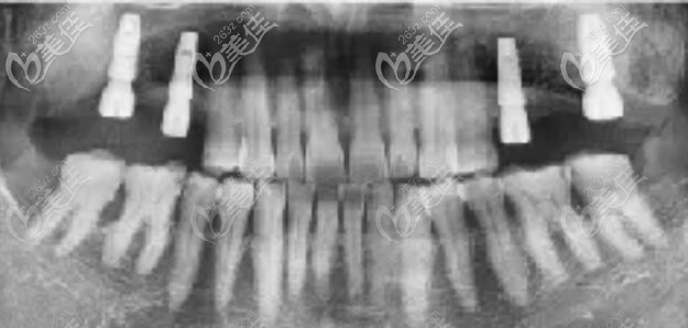 上半口缺失四颗牙的李阿姨牙槽骨萎缩，在儿女坚持下做了瑞士ITI种植牙