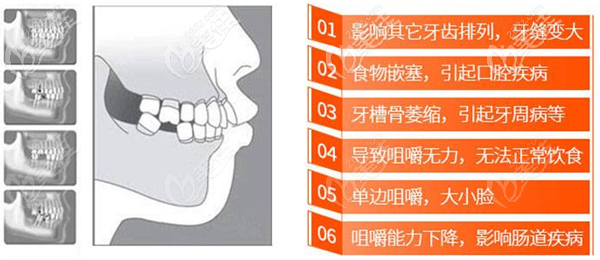 牙齿缺失会引起很多问题