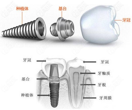 瑞士ITI种植体 瑞士ITI种植体