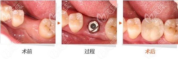去年在深圳光美口腔做了一颗瑞士ITI种植牙，真心觉得选择好植体就是不一样