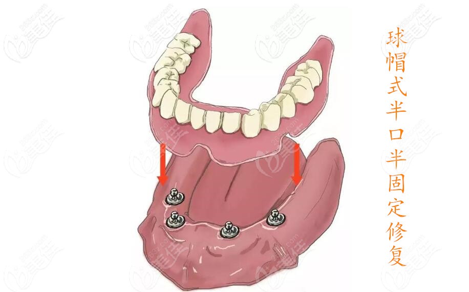 半口半固定球帽式修复