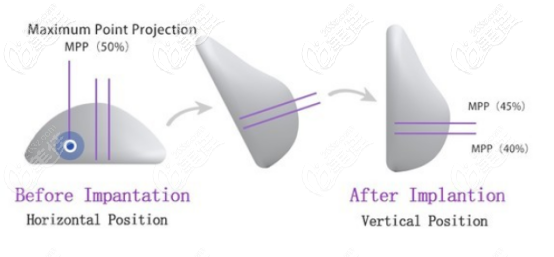 魔滴假体的形状