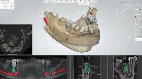 采集数据设计种植牙导板