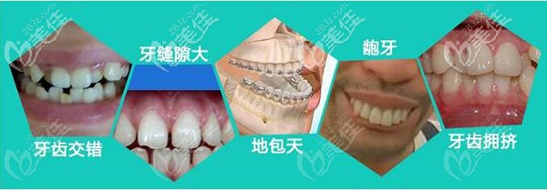 3M金属托槽能解决的问题