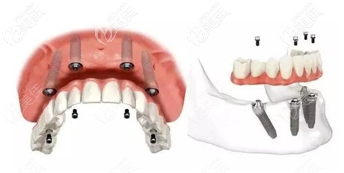 大连牙元素刘洋医生种植牙优势
