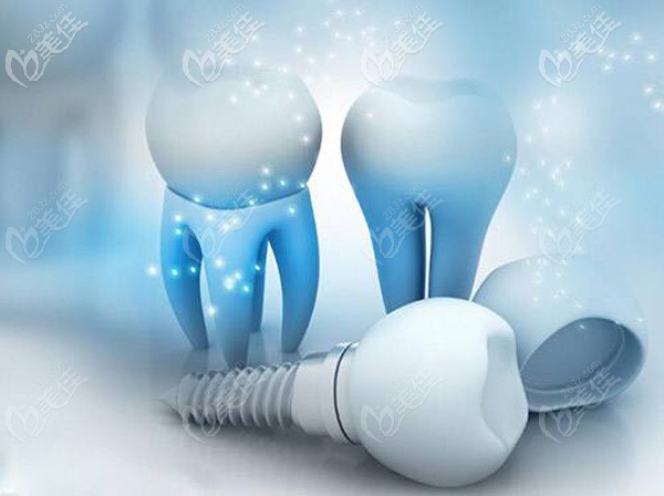 怎么选择种植牙