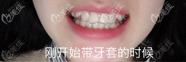 做隐形牙套矫正术前照 做隐形牙套矫正术前照