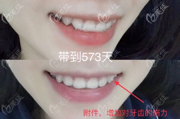 在深圳做时代天使隐形牙齿矫正多少钱?答案由我来告诉你!