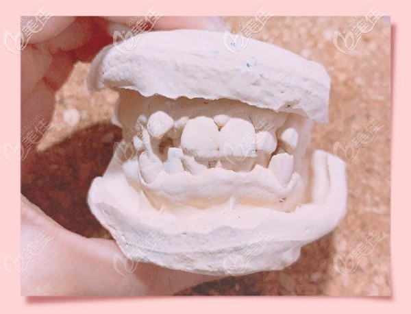 医生当时做的牙齿模型