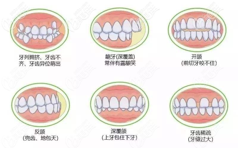 牙齿不齐的危害