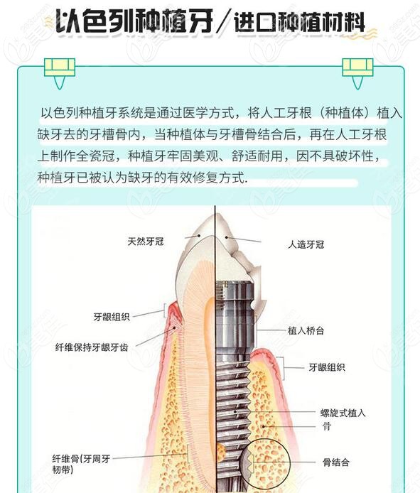 以色列种植牙怎么样