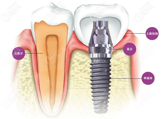 以色列和瑞士种植体哪个好
