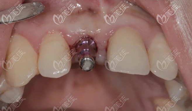 洛阳济仁口腔前牙美学种植 洛阳济仁口腔前牙美学种植