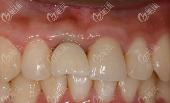 当天种植戴入临时牙效果图 当天种植戴入临时牙效果图