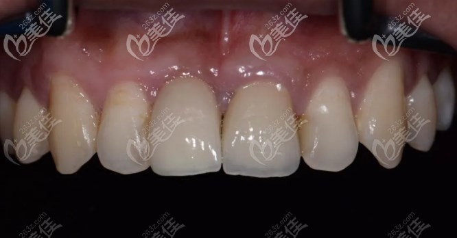 看洛阳济仁口腔的前牙缺失种植案例,在这家种牙效果好还不贵哦