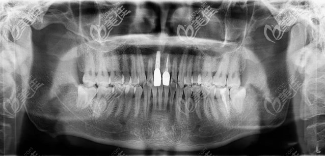 种植牙完后的X线片