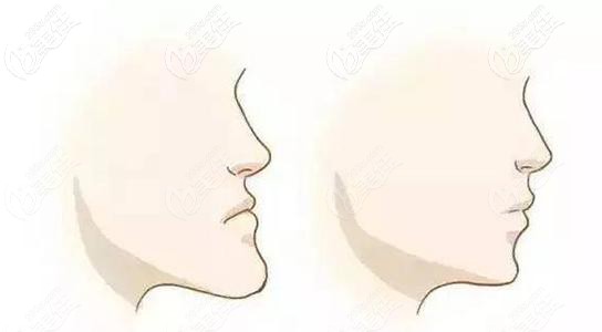 朱彩寅医生浅谈牙齿矫正能改变脸型吗 朱彩寅医生浅谈牙齿矫正能改变脸型吗