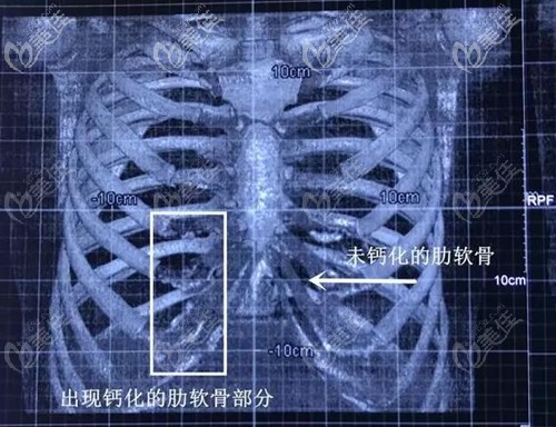肋软骨钙化和正常肋软骨的区别 肋软骨钙化和正常肋软骨的区别