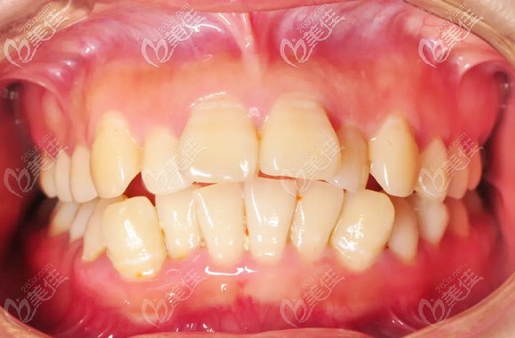 做矫正前的口内照 做矫正前的口内照