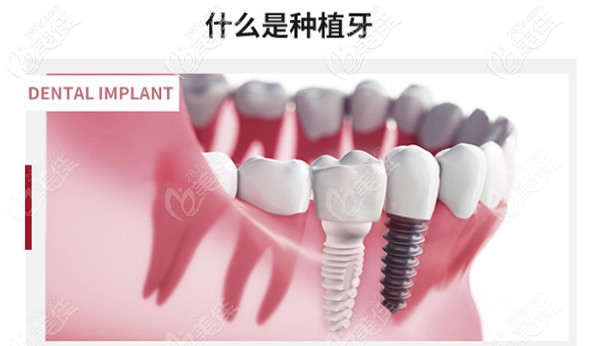 什么是种植牙 什么是种植牙
