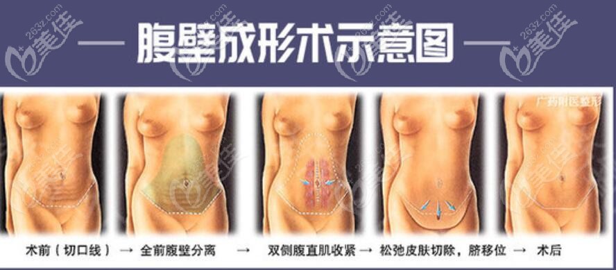 腹壁成形术过程示意图