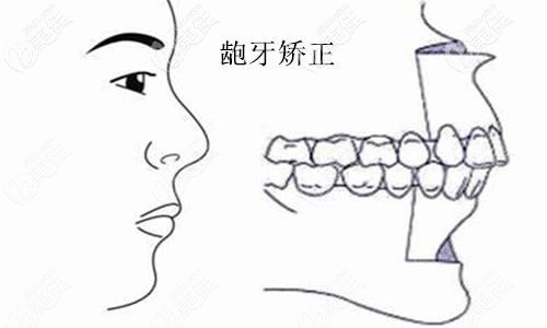 龅牙矫正的情况 龅牙矫正的情况