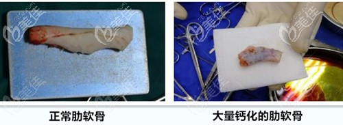 正常肋软骨和钙化的肋软骨 正常肋软骨和钙化的肋软骨