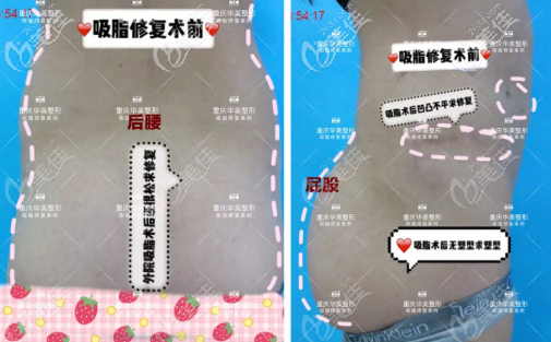 吸脂失败照片 吸脂失败照片