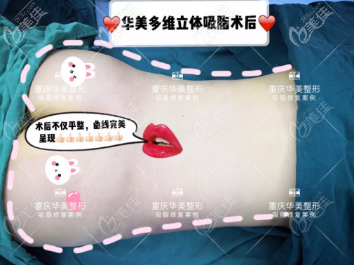 重庆华美多维立体吸脂案例 重庆华美多维立体吸脂案例