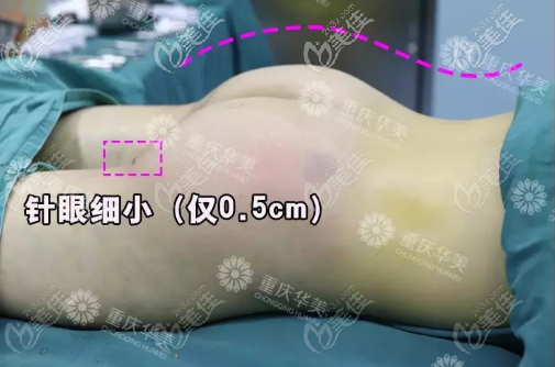 0.5厘米的针眼 0.5厘米的针眼