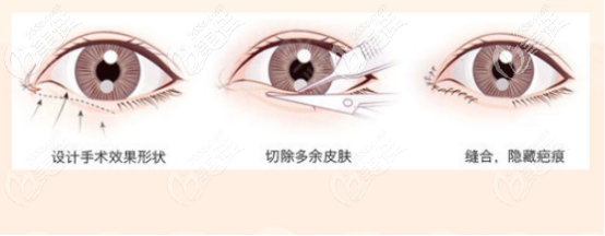 姜辉院长双眼皮的手术流程