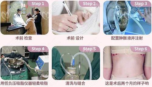 水动力腰腹吸脂过程 水动力腰腹吸脂过程