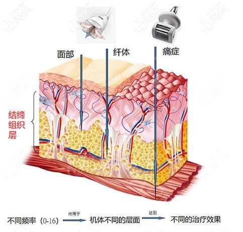 法国LPG原理
