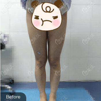 在北京蒂凡妮医疗美容做大腿吸脂前 在北京蒂凡妮医疗美容做大腿吸脂前